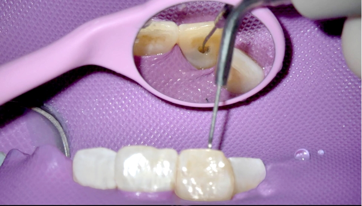 图片 右上颌中切牙数字化导板引导下根管治疗