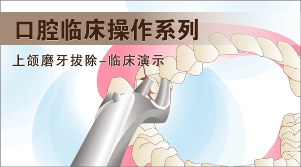 图片 上颌磨牙拔除-临床手术