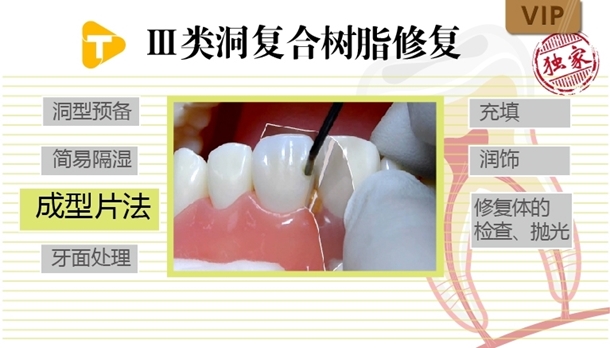 图片 成型片法