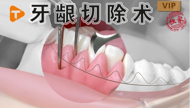 图片 牙龈切除术