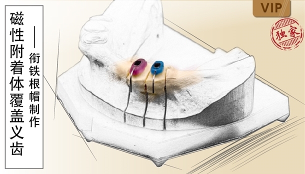 图片 磁性附着体覆盖义齿-衔铁根帽制作