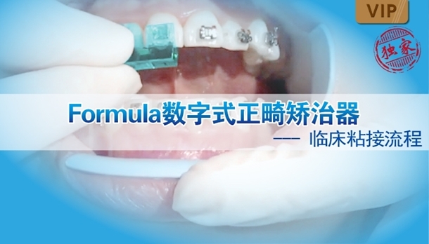 图片 Formula数字式正畸矫治器临床粘接流程