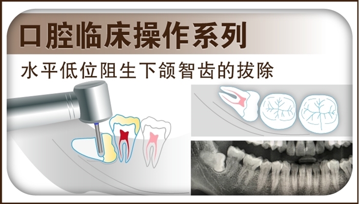 图片 水平低位阻生下颌智齿的拔除