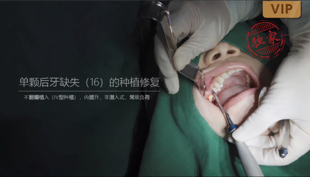 图片 单颗后牙缺失（16）的种植修复