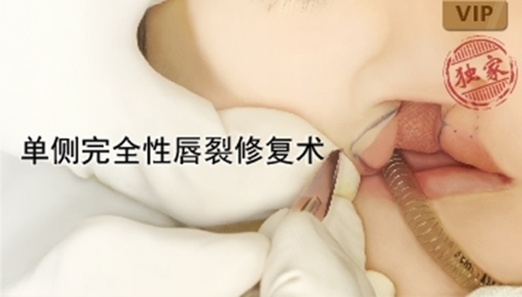 图片 单侧完全性唇裂修复术