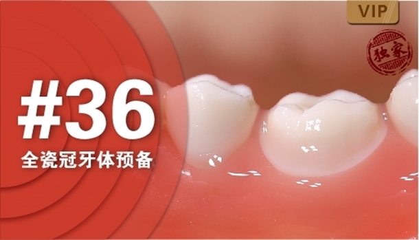 图片 #36全瓷冠牙体预备