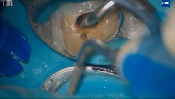 图片 应用根尖屏障术行上颌第一恒磨牙根管再治疗一例
