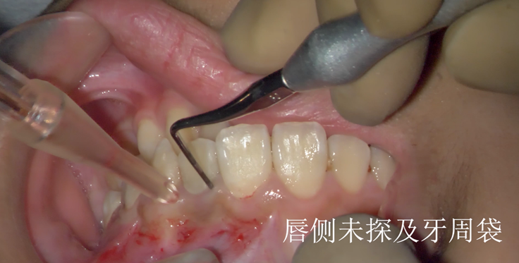 图片 意向性牙再植术治疗上颌侧切牙畸形舌侧沟一例