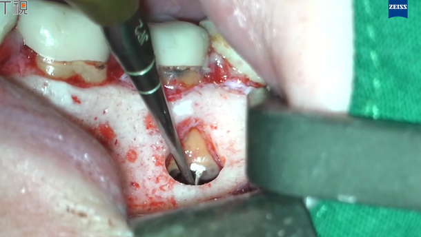 图片 动态导航引导下左下后牙显微根尖手术一例