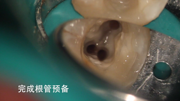 图片 右下第二磨牙慢性牙髓炎显微根管治疗