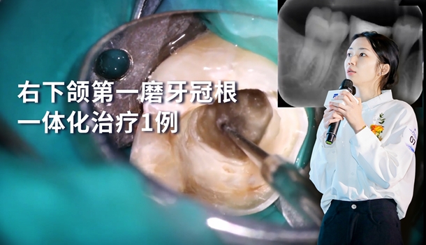 图片 右下颌第一磨牙冠根一体化治疗1例