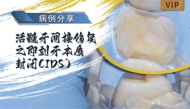图片 活髓牙间接修复之即刻牙本质封闭(IDS)