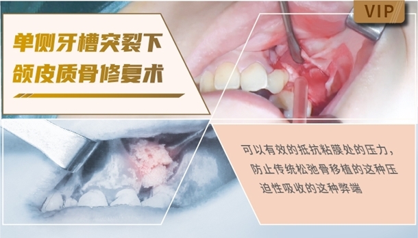 图片 单侧牙槽突裂下颌皮质骨修复术