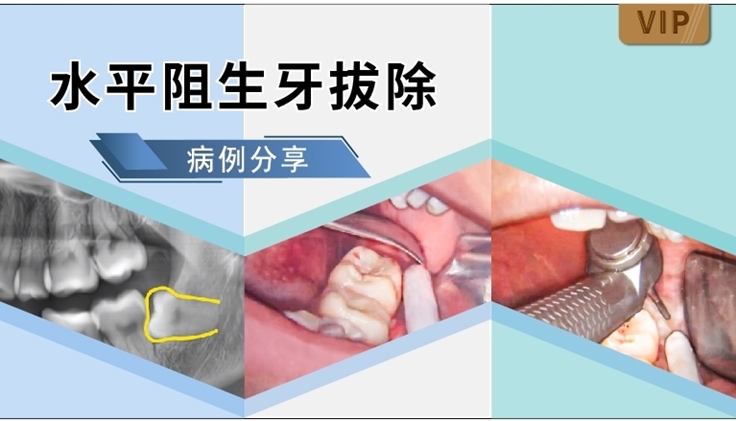 图片 水平阻生牙拔除