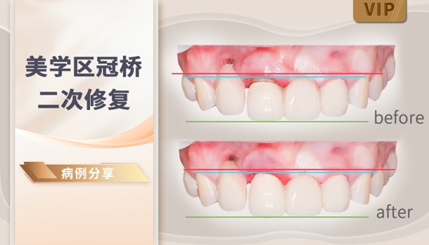 图片 美学区冠桥二次修复