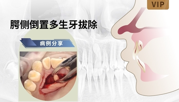 图片 腭侧倒置多生牙拔除