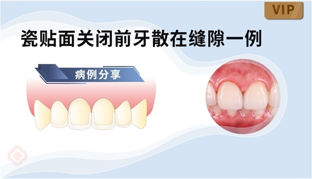 图片 瓷贴面关闭前牙散在缝隙一例