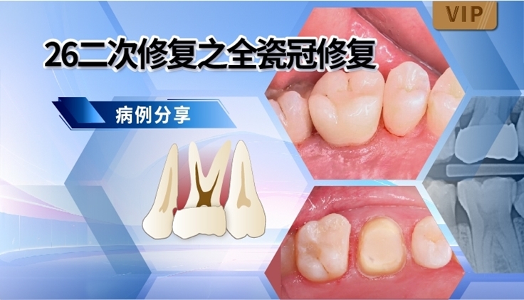 图片 26二次修复之全瓷冠修复