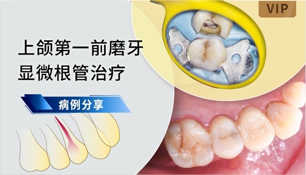 图片 上颌第一前磨牙显微根管治疗