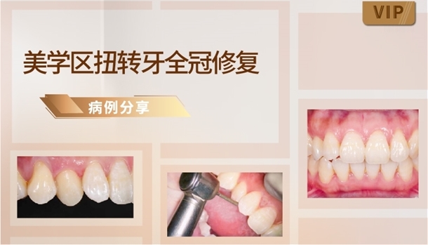 图片 美学区扭转牙全冠修复