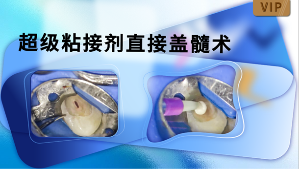 图片 超级粘接剂直接盖髓术