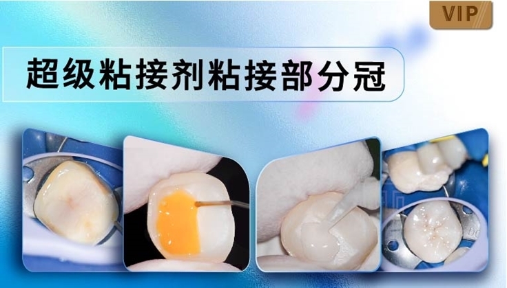 图片 超级粘接剂粘接部分冠