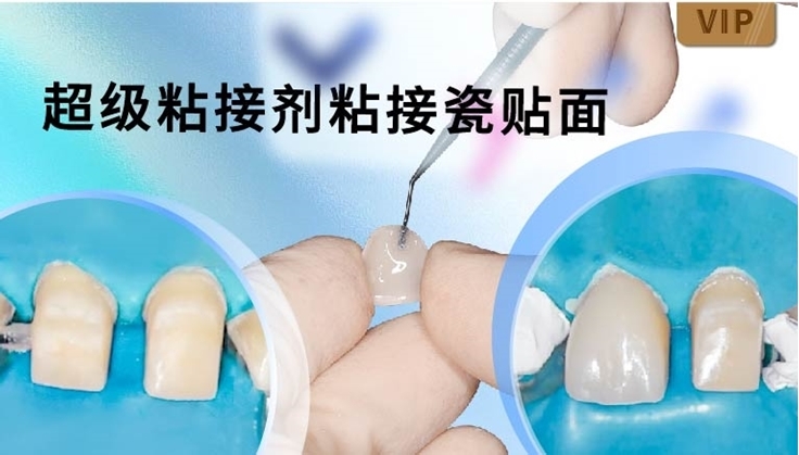 图片 超级粘接剂粘接瓷贴面