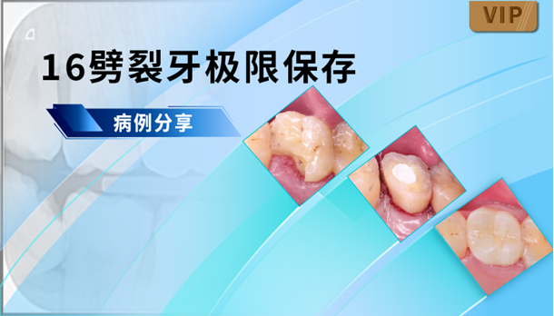 图片 16劈裂牙极限保存